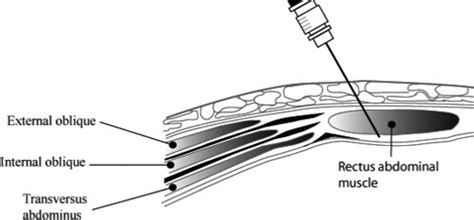 Trunk blocks for abdominal surgery - Finnerty - 2010 - Anaesthesia ...