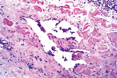 Pathology Outlines - Kaposi sarcoma