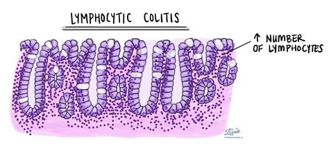 Microscopic colitis | MyPathologyReport.ca