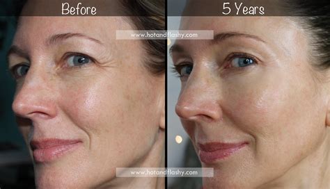 5-Year Retin-A Results ~ Before & After for Wrinkles & Anti-Aging – hotandflashy.com