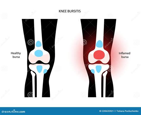 Knee Bursitis_Prepatellar Bursitis Vector Illustration | CartoonDealer ...