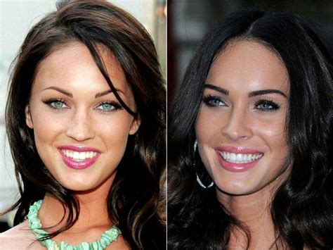 Celebrities With Veneers Before And After | Before And After