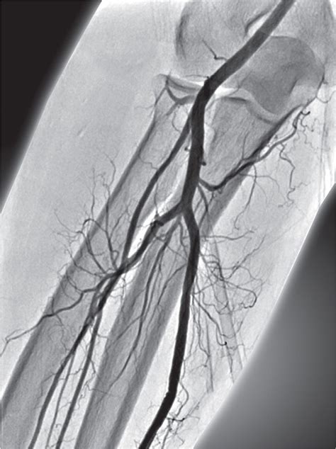 Radial Artery versus Ulnar Artery Catheterization | Thoracic Key