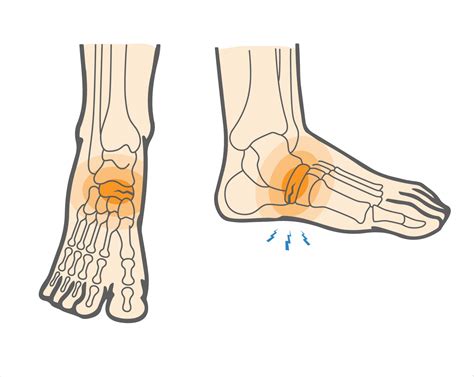 What is Navicular Stress Fracture & How to Heal Foot Injuries? - Upswing Health