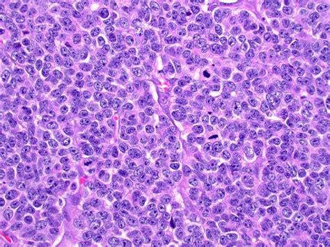 Pathology Outlines - Neuroendocrine neoplasms-general