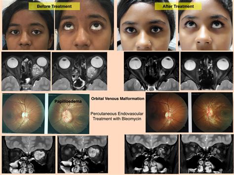 Orbital Low... - Srinivasan Paramasivam - Hybrid Neurosurgeon