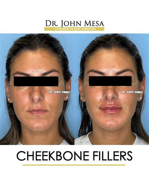 Cheekbone Filler Before & After Photos | Dr. Mesa