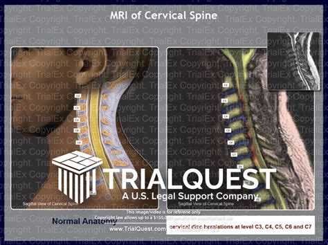 MRI of Cervical Spine - TrialQuest Inc.