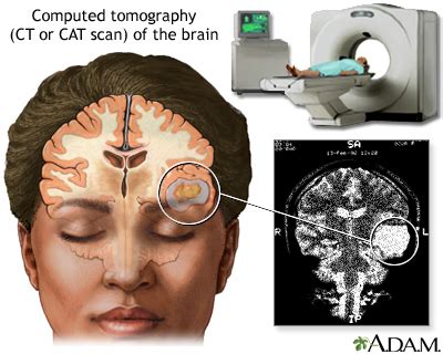 CT scan of the brain: MedlinePlus Medical Encyclopedia Image