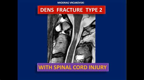 Type 2 Dens Fracture - Case Report & Treatment - YouTube