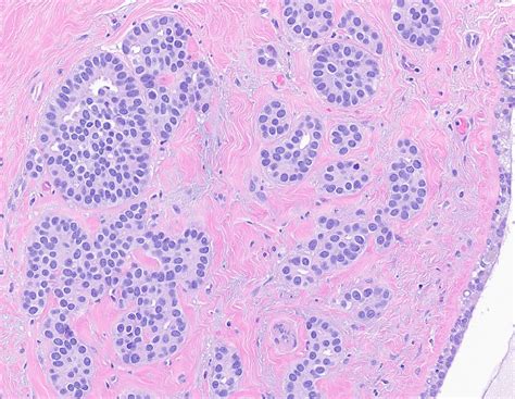 Invasive Ductal Carcinoma Histology