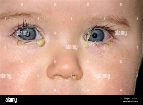 Baby suffering from conjunctivitis infection of the eye Stock Photo ...