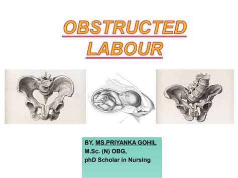 Obstructed labour | PPT