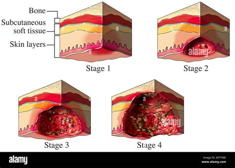 Stages Of Pressure Ulcers Chart Poster Laminated | atelier-yuwa.ciao.jp