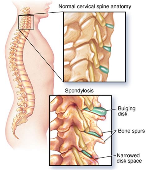 Spondylosis | Aptiva Health