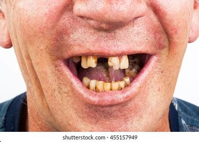 1,504 Smoker teeth Images, Stock Photos & Vectors | Shutterstock