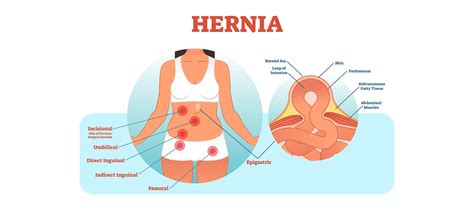 Hernioplasty: An Introduction, Procedure, Recovery, Risks & Complications | Meril Life