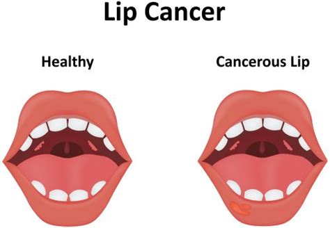 Causes of the White Bumps on Lips | STD.GOV Blog