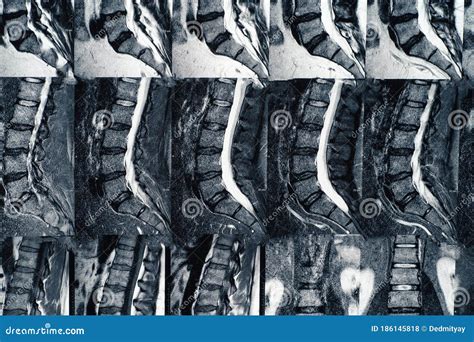 Diagnosis Of Pinched Nerve. Medical Health History Written With Diagnosis Of Pinched Nerve, MRI ...