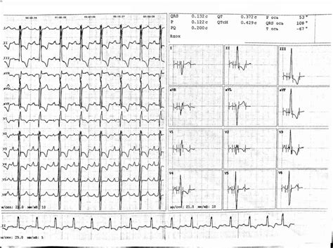 Electrocardiogram before treatment | Download Scientific Diagram