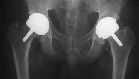 Hip Resurfacing - Medical Tourism Procedure - The Travel Pharmacist