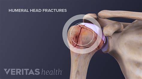 The 3 Types of Shoulder Fractures