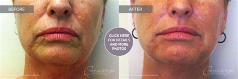 Before and After Photos - Juvederm Ultra and Voluma | Concierge Aesthetics