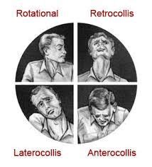 retrocollis and torticollis - distonías cervicales, permanentes o esporádicas. | Torticollis ...