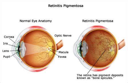 Retinitis Pigmentosa: Causes, Symptoms & Treatments | Global Treatment Services Pvt. Ltd.