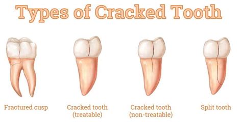 Cracked tooth? Your Fort Lauderdale Cosmetic Dentist has treatment options for your cracked ...