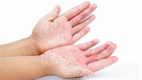 Allergic Contact Dermatitis: Prevention, Treatment, and How Can Compounding Help