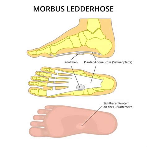 Morbus Ledderhose » Ursachen, Symptome, Behandlung