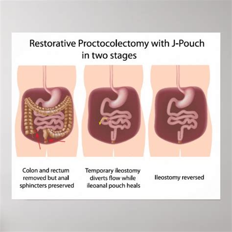 Restorative proctocolectomy with j-pouch 2 stages poster | Zazzle