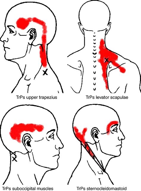 Levator Scapulae Trigger Points