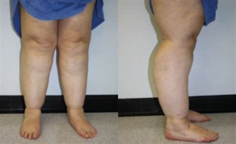 Lipoedema - a long term and complex condition that affects women