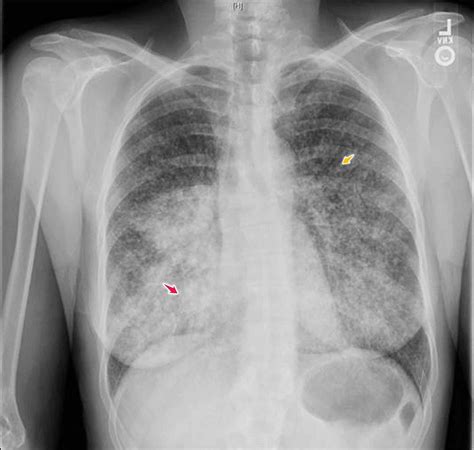 Cureus | Adenocarcinoma of the Lung Presenting with Intrapulmonary Miliary Metastasis