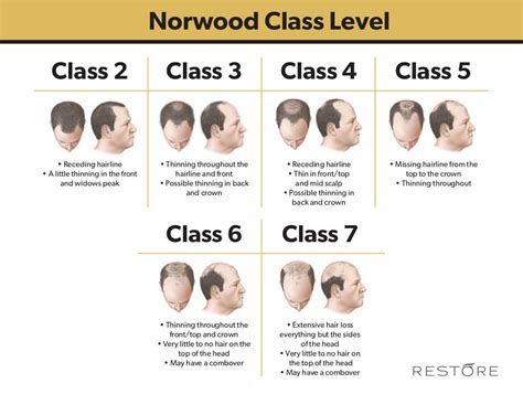 Norwood Scale for Balding - Norwood Chart | RESTORE Hair