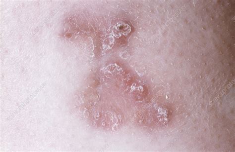 Cutaneous tuberculosis - Stock Image - C055/9815 - Science Photo Library