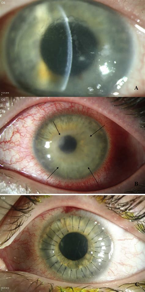 Acanthamoeba keratitis causes, signs, symptoms, diagnosis, treatment ...