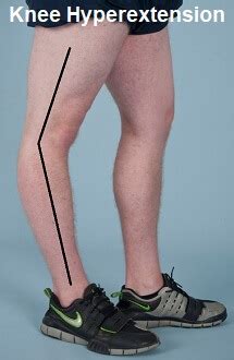 Hyperextended Knee: Symptoms, Causes & Treatment