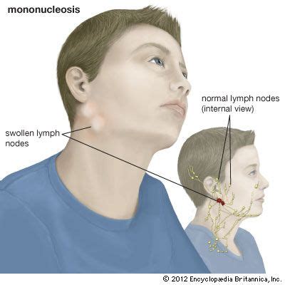 Infectious Mononucleosis Swollen Lymph Nodes