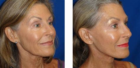 Facelift Before and After Pictures - Orlando FL | YMD Eye & Face