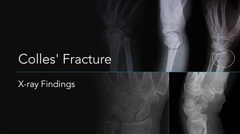 Colles' Fracture: X-ray Findings - YouTube