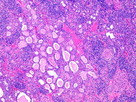 Pathology Outlines - Eccrine spiradenoma