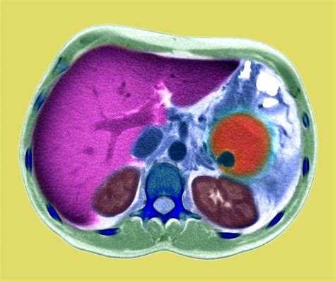 Pancreatitis, Ct Scan Photograph by Du Cane Medical Imaging Ltd | Pixels