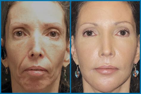 micro needling before and after - Google Search | Microneedling ...