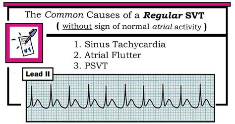 ECG Interpretation: ECG Interpretation Review #40 (Regular SVT - List 1 - Flutter - PSVT - Sinus ...