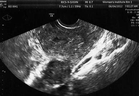 Ultrasonography Of Uterine Fibroids (Chapter 11), 48% OFF