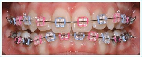 20 best images about Braces Colors on Pinterest