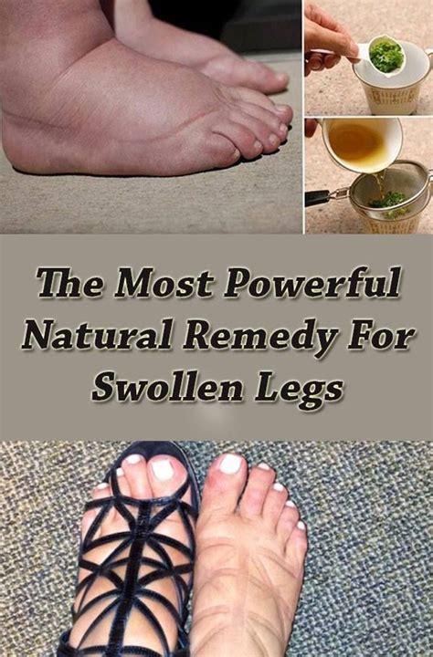 The+Most+Powerful+Natural+Remedy+For+Swollen+Legs | Swollen legs, Foot ...